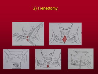 2) Frenectomy
 