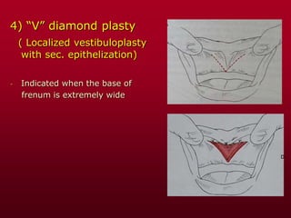 4) “V” diamond plasty
( Localized vestibuloplasty
with sec. epithelization)
- Indicated when the base of
frenum is extremely wide
 