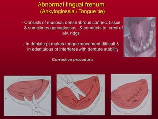 Abnormal lingual frenum
(Ankyloglossia / Tongue tie)
- Consists of mucosa, dense fibrous connec. tissue
& sometimes genioglossus , & connects to crest of
alv. ridge
- In dentate pt makes tongue movement difficult &
in edentulous pt interferes with denture stability
- Corrective procedure
 