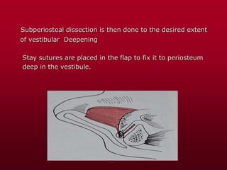 Subperiosteal dissection is then done to the desired extent
of vestibular Deepening
Stay sutures are placed in the flap to fix it to periosteum
deep in the vestibule.
 