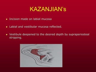 KAZANJIAN’s
 Incision made on labial mucosa
 Labial and vestibular mucosa reflected.
 Vestibule deepened to the desired depth by supraperiosteal
stripping.
 