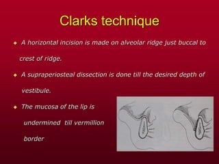 Clarks technique
 A horizontal incision is made on alveolar ridge just buccal to
crest of ridge.
 A supraperiosteal dissection is done till the desired depth of
vestibule.
 The mucosa of the lip is
undermined till vermillion
border
 