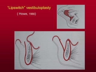 “Lipswitch” vestibuloplasty
( Howe, 1966)
 