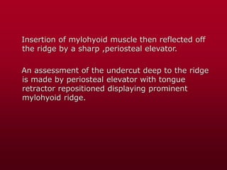 Insertion of mylohyoid muscle then reflected off
the ridge by a sharp ,periosteal elevator.
An assessment of the undercut deep to the ridge
is made by periosteal elevator with tongue
retractor repositioned displaying prominent
mylohyoid ridge.
 