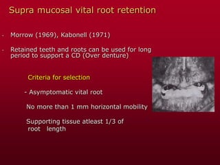 Supra mucosal vital root retention
- Morrow (1969), Kabonell (1971)
- Retained teeth and roots can be used for long
period to support a CD (Over denture)
Criteria for selection
- Asymptomatic vital root
No more than 1 mm horizontal mobility
Supporting tissue atleast 1/3 of
root length
 