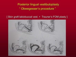 Posterior lingual vestibuloplasty
“ Obwegesser’s procedure ”
[ Skin graft labiobuccal vest. + Trauner’s FOM plasty ]
 