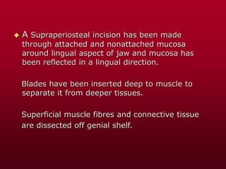  A Supraperiosteal incision has been made
through attached and nonattached mucosa
around lingual aspect of jaw and mucosa has
been reflected in a lingual direction.
Blades have been inserted deep to muscle to
separate it from deeper tissues.
Superficial muscle fibres and connective tissue
are dissected off genial shelf.
 