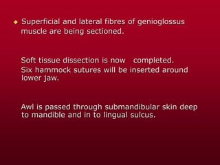  Superficial and lateral fibres of genioglossus
muscle are being sectioned.
Soft tissue dissection is now completed.
Six hammock sutures will be inserted around
lower jaw.
Awl is passed through submandibular skin deep
to mandible and in to lingual sulcus.
 