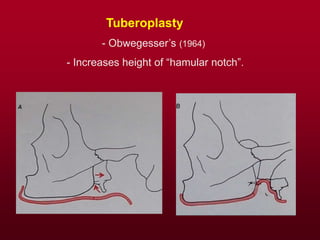 Tuberoplasty
- Obwegesser’s (1964)
- Increases height of “hamular notch”.
 