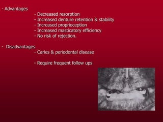 - Advantages
- Decreased resorption
- Increased denture retention & stability
- Increased proprioception
- Increased masticatory efficiency
- No risk of rejection.
- Disadvantages
- Caries & periodontal disease
- Require frequent follow ups
 