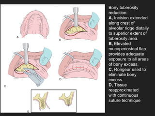 Pre prosthetic surgeries | PPT