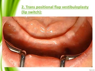 2. Trans positional flap vestibuloplasty
(lip switch):
 