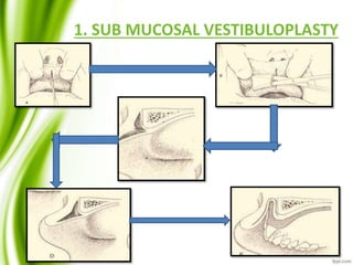 1. SUB MUCOSAL VESTIBULOPLASTY
 