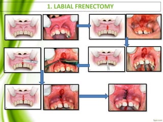 1. LABIAL FRENECTOMY
 