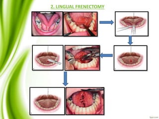 2. LINGUAL FRENECTOMY
 