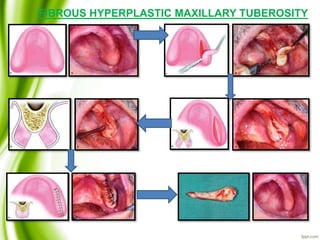 FIBROUS HYPERPLASTIC MAXILLARY TUBEROSITY
 
