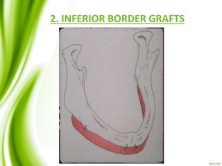 2. INFERIOR BORDER GRAFTS
 
