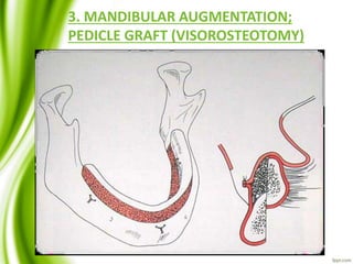 3. MANDIBULAR AUGMENTATION;
PEDICLE GRAFT (VISOROSTEOTOMY)
• The mandible is split sagitally in the
buccolingual dimension and the lingual
cortex is moved vertically to gain height.
 
