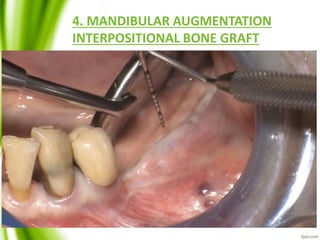 4. MANDIBULAR AUGMENTATION
INTERPOSITIONAL BONE GRAFT
 