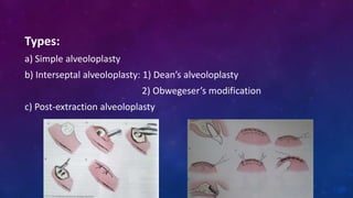 Types:
a) Simple alveoloplasty
b) Interseptal alveoloplasty: 1) Dean’s alveoloplasty
2) Obwegeser’s modification
c) Post-extraction alveoloplasty
 