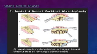 SIMPLE ALVEOLOPLASTY
 