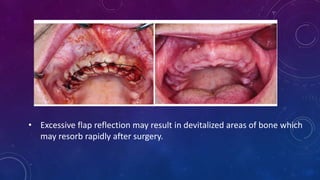 • Excessive flap reflection may result in devitalized areas of bone which
may resorb rapidly after surgery.
 