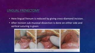 LINGUAL FRENECTOMY
• Here lingual frenum is reduced by giving cross-diamond incision.
• After incision sub mucosal dissection is done on either side and
vertical suturing is given.
 