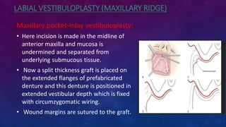 Split Ridge Maxilla Preprosthetic surgery; Prosthodontic consideraration | PPTX