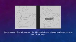 This technique effectively increases the ridge height from the lateral maxillary area to the
crest of the ridge.
 