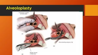 Alveoloplasty
 