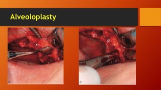 Alveoloplasty
 