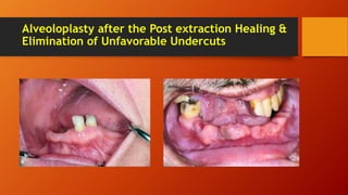 Alveoloplasty after the Post extraction Healing &
Elimination of Unfavorable Undercuts
 