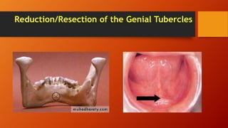 Reduction/Resection of the Genial Tubercles
 