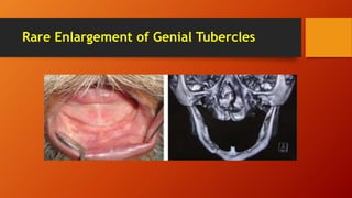 Rare Enlargement of Genial Tubercles
 