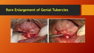 Rare Enlargement of Genial Tubercles
 