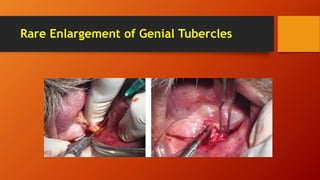 Rare Enlargement of Genial Tubercles
 