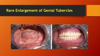 Rare Enlargement of Genial Tubercles
 