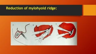 Reduction of mylohyoid ridge:
 