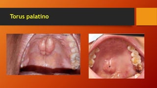 Torus palatino
 