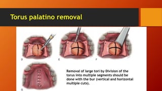 Torus palatino removal
Removal of large tori by Division of the
torus into multiple segments should be
done with the bur (vertical and horizontal
multiple cuts).
 