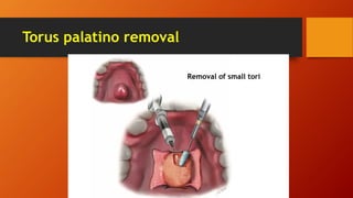 Torus palatino removal
Removal of small tori
 