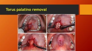 Torus palatino removal
 
