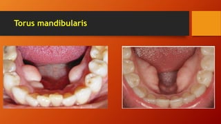 Torus mandibularis
 