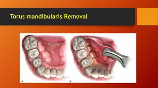 Torus mandibularis Removal
 