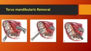 Torus mandibularis Removal
 