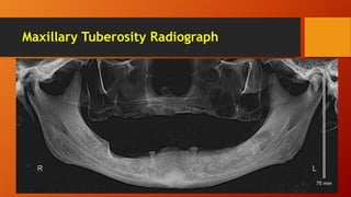 Maxillary Tuberosity Radiograph
 