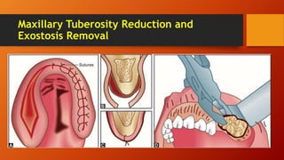 Maxillary Tuberosity Reduction and
Exostosis Removal
 
