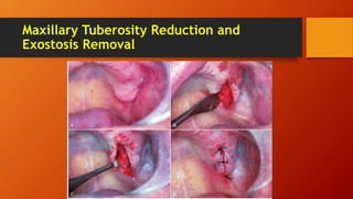 Maxillary Tuberosity Reduction and
Exostosis Removal
 