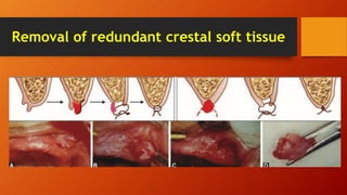 Removal of redundant crestal soft tissue
 
