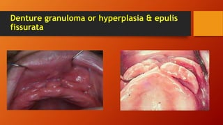 Denture granuloma or hyperplasia & epulis
fissurata
 